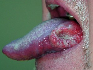 oral-cancer